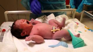 Baby 3 Live Birth in 4K UHD Video Csection Operation Delivery camera recording [upl. by Scever]