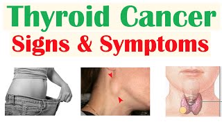 Thyroid Cancer Signs amp Symptoms amp Why They Occur [upl. by Aliemaj709]