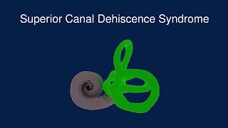 Superior Canal Dehiscence Syndrome SCDS [upl. by Arual845]