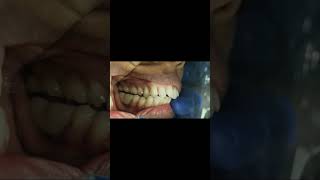 First and second mandibular molar implant bridge occlusal check for interference shorts [upl. by Neila]