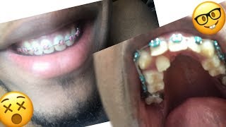 BRACES UPDATE  Whats Up With My Teeth  Stainless Steel Wire [upl. by Eserehs]