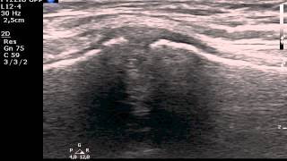 Manubriosternal joint MSKUS ultrasound [upl. by Pentheam307]