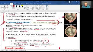 Aortic stenosis 2025 [upl. by Ael]