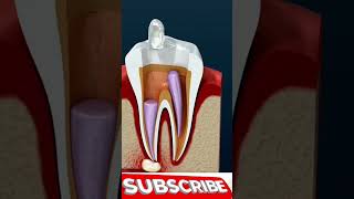 Root Canal Treatment amp Tooth AbscessRoot shorts viralvideo viralshorts [upl. by Kirschner552]