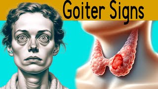 Goiter explained under 3 minutes Causes Symptoms Treatment [upl. by Yduj]