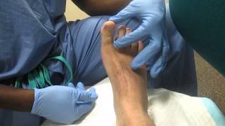 Hallux Block MWMC Podiatry [upl. by Reis632]