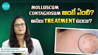 Molluscum Contagiosum Treatment in telugu  Molluscum Contagiosum Cream Virus and Symptoms Keha [upl. by Retrac]