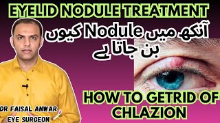 Chlazion  Treatment  Causes and Diagnosis Chlazion Removal drfaisalanwar eyelidnodule Chlazion [upl. by Davida]