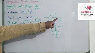 FCPS part 1CVS lecture 20 ACYANOTIC HEART DISEASES made easy [upl. by Eigla]