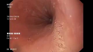 EGD  esophagogastroduodenoscopy [upl. by Sievert675]