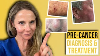 Actinic keratosis treatment guide from a Dermatologist [upl. by Aihselat]