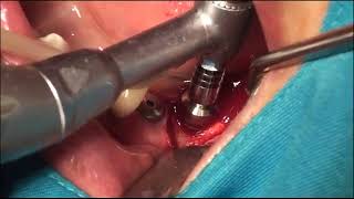 IT 5507 short implant placement in the lower 2nd molar with VARO Guide [upl. by Brag430]