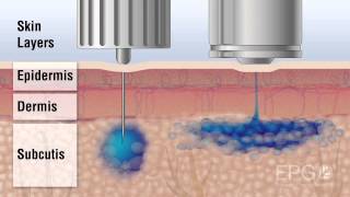 Needle vs InsuJet™ Nozzle injection [upl. by Ivon]