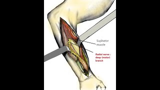 Dorsal Approach to the Radial DiaphysisThompson Approach [upl. by Levesque]