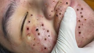 Remove Blackheads and Pustules on Chin [upl. by Maclaine]