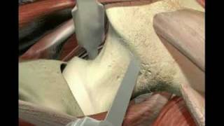 3D Medical Animation MicroHip Total Hip Joint Replacement Surgery THR by Dr Markus C Michel [upl. by Crandell808]