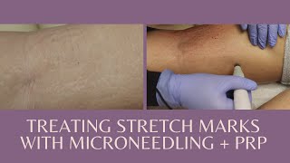 Treating stretch marks with Microneedling  PRP [upl. by Moira]