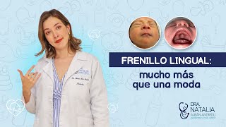 Frenillo Lingual  Dra Natalia [upl. by Araihc]