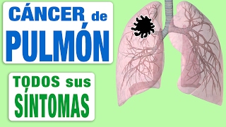 Todos Los Síntomas del Cáncer de Pulmón [upl. by Hairabez]