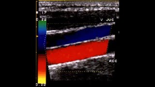 ECO COLOR DOPPLER TSA  ROMA 2003 [upl. by Nasah219]