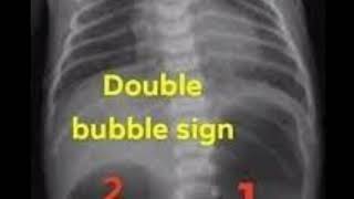 Duodenal atresia  remember 4 Ds Duodenal atresia double bubble sign down syndrome Duodeostomy [upl. by Seel]