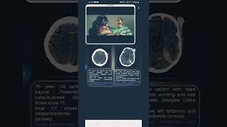 contusion vs subduralhematoma [upl. by Ihsoyim]