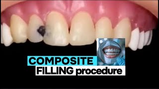 Tooth filling procedure  tooth filling cavity  dental filling procedure dentist ndc [upl. by Rabelais112]