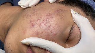 ACNE TREATMENT VU QUYNH MI  Blackheads On Boy Face 2024FULL [upl. by Vizza]