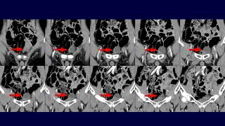 A cystic pelvic mass with recurrent gastric cancer DDx cystic metastasis vs urachal cyst [upl. by Ahsyla]