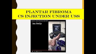 Injection  plantar fibromas under USS [upl. by Ynnod]