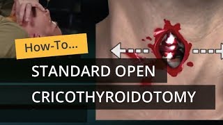 Standard Open Cricothyroidotomy [upl. by Nofets]