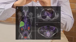 PET PSMA indicações [upl. by Iloj625]