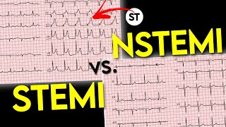 ECG interpretation  STEMI vs NSTEMI  ECG of Myocardial Infraction • Daily Cardiology [upl. by Yager]