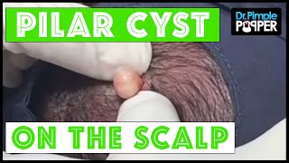 A Perfect Pilar Cyst Pop Dr Pimple Popper amp Buzzfeed [upl. by Bruning814]