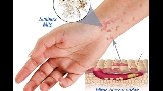 Scabies Causes Symptoms and Treatment [upl. by Eenad]