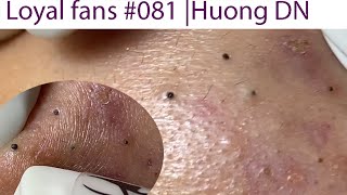 Acne Treatment Huong Da Nang 081  Loyal fans [upl. by Yunfei445]