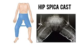 HIP SPICA CAST APPLICATION FOR A 14 MONTHS OLD KID WITH FEMUR SHAFT SPIRAL OBLIQUE FRACTURE [upl. by Daffy]