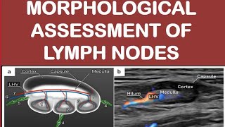 Morphological assessment of lymph nodes [upl. by Cornelius]