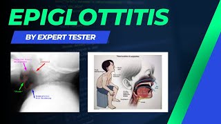 Epiglottitis  Causes  Symptoms  Diagnosis  Treatment amp Pathology [upl. by Marketa]