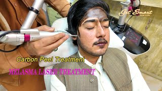 melasma laser treatment Carbon Peel Laser  4k video [upl. by Yentnuoc635]