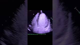 Diagnosis echocardiography [upl. by Sy]