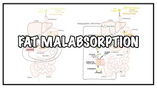 Approach to Fat malabsorption  signs and symptoms and causes [upl. by Tnafni]