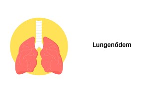 Lungenödem  Erkrankungen der Atemwege [upl. by Mur]