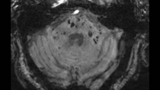 Multiple Cavernoma Syndrome [upl. by Anaoy]