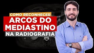 Você precisa conhecer estes acidentes anatômicos na radiografia de tórax  Galvani Filho [upl. by Ettolrahc]