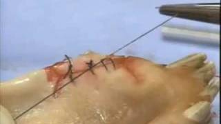 Introduction to Periodontal Surgery Techniques Initial Incisions and Suturing [upl. by Sucramej]