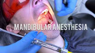 Techniques for Mandibular Anaesthesia  VaziraniAkinosi Mandibular Block Technique dentist dental [upl. by Freddie]