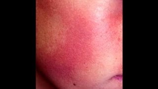 Keratosis Pilaris of the Face DermTVcom Epi 451 [upl. by Aldred677]