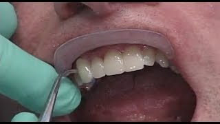 Robert A Lumineers Veneers Case Study  30Second Dentistry™ [upl. by Autum817]