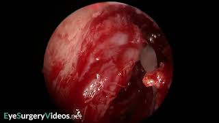 Lacrimal sac diverticulum [upl. by Repohtsirhc51]